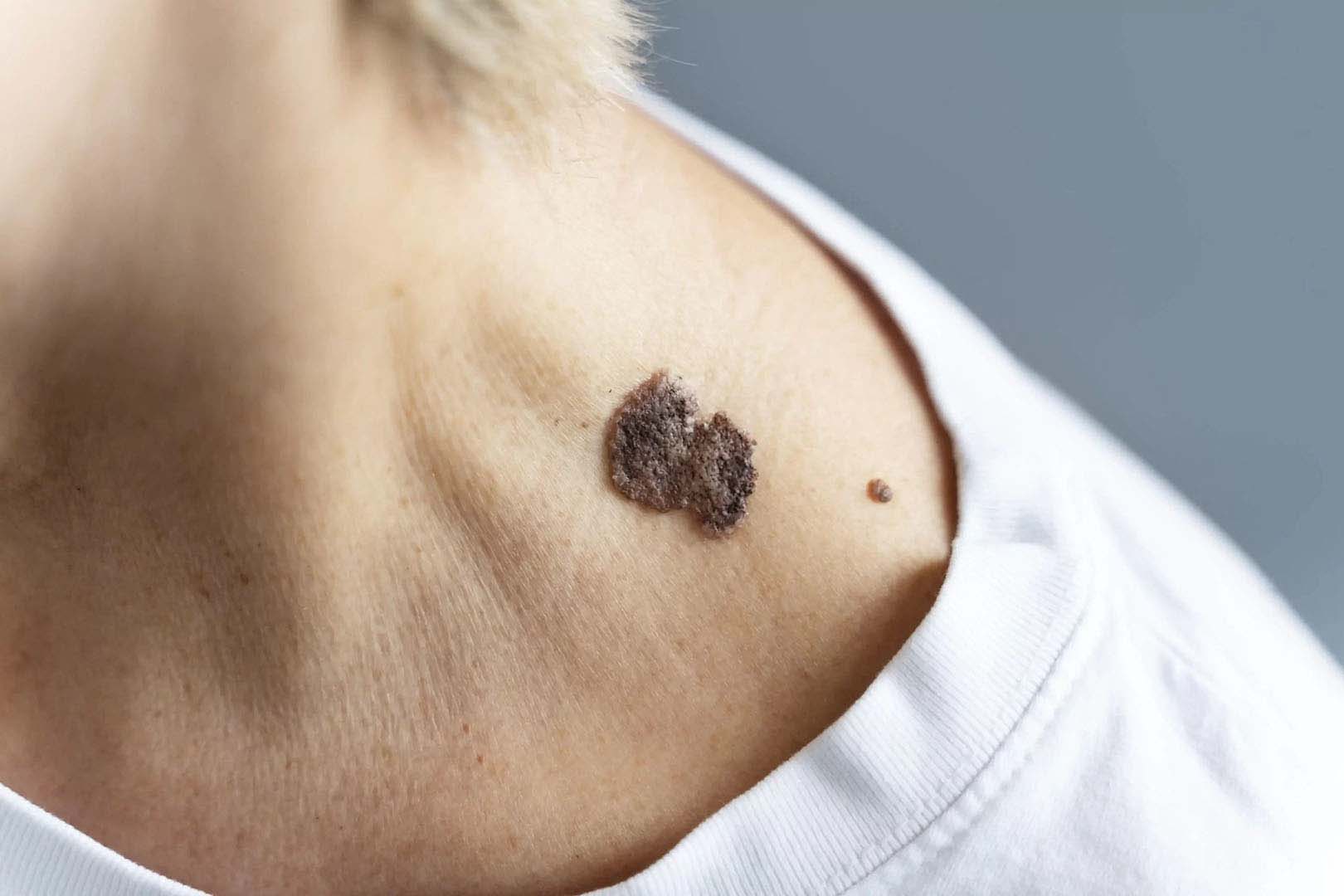 Anyajegyszűrés: minden, amit tudnod kell a melanoma megelőzéséről Anyajegyszűrés: minden, amit tudnod kell a melanoma megelőzéséről