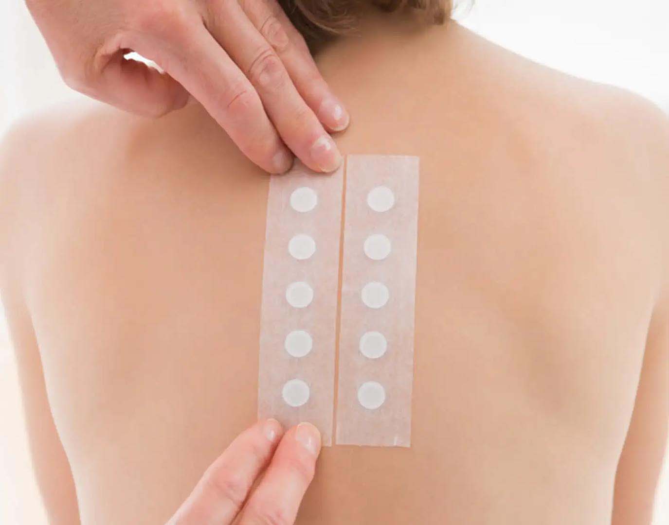 Fémallergia diagnosztizálása epicutan allergiateszt segítségével Fémallergia diagnosztizálása epicutan allergiateszt segítségével