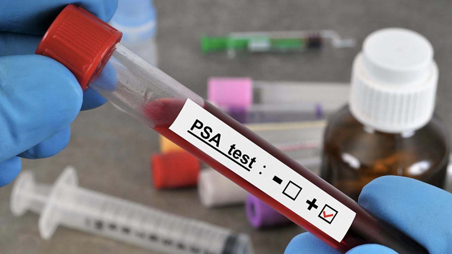 Prosztataszűrés – Kinek? Mikor? Miért? Prosztataszűrés – Kinek? Mikor? Miért?